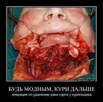 242412-budi_modnym_kuri_dalishe_operatsiia_po_udaleniiu_raka_gorla_u_kurilischika.webp 242412-budi_modnym_kuri_dalishe_operatsiia_po_udaleniiu_raka_gorla_u_kurilischika.webp